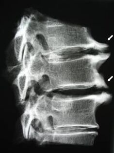 Osteofity kręgosłupa szyjnego powodują ból szyi