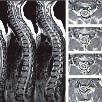 diagnoza osteochondrozy klatki piersiowej