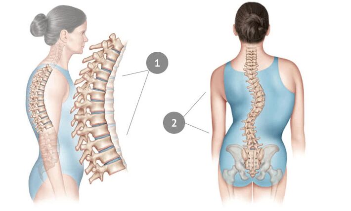 skrzywienie kręgosłupa jako przyczyna osteochondrozy klatki piersiowej