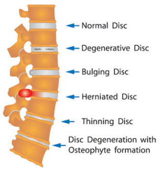 różne uszkodzenia dysku kręgosłupa